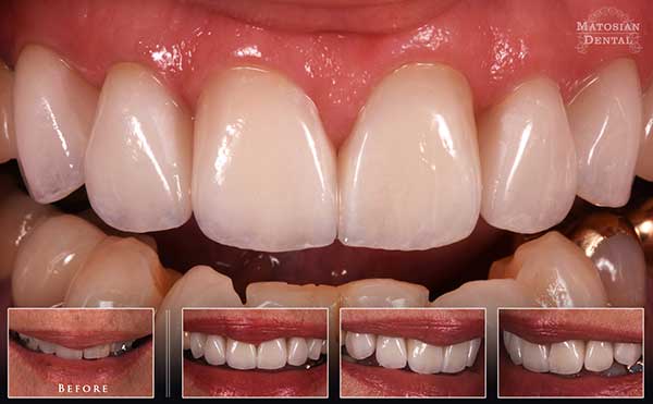La Mesa Before and After Teeth Whitening