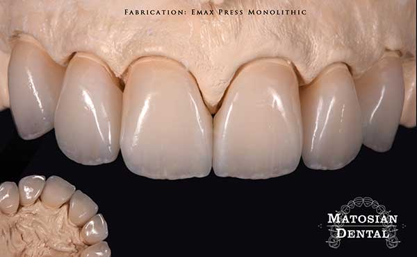 La Mesa Before and After Dental Implants